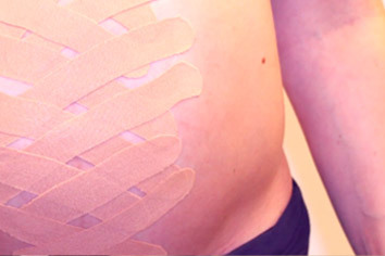 How do I tape my pregnant belly? Dealing with a diastasis of the abdominal muscles.